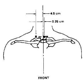 JFK neck wound according to HSCA. Originated from the HSCA report, a US Government report, HSCA Vol.6 p.43.