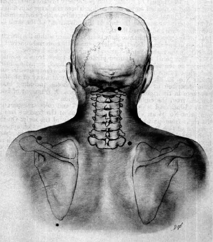 JFK wounds according to HSCA. Originated from the HSCA report, a US Government report, HSCA Vol.7 p.117.